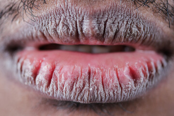 Close up of dry lip of a young men 