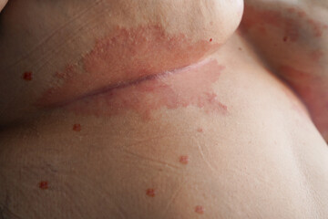 Psoriasis skin. Psoriasis is an autoimmune disease that affects the skin cause skin inflammation...