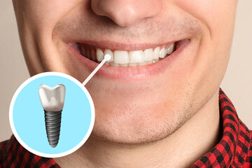 Happy man with perfect teeth smiling on beige background, closeup. Illustration of dental implant