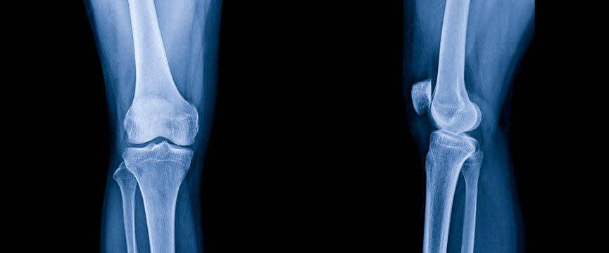 Blue tone radiograph on dark background in hospital.Doctor used xray for diagnosis of the illness of patient.X-ray of normal knee in AP and lateral in orthopedic unit.Xray in hospital.Medical concept.