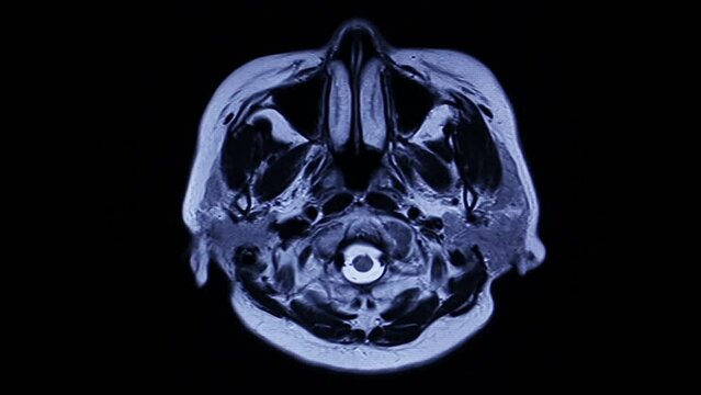 MRI brain scan on black background
