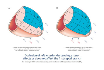 When the LAD occlusion affects or does not affect the first septal branch, it determines whether the anterior septal myocardial infarction occurs.