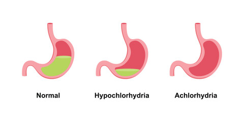 Scientific Designing of Difference Between Hypochlorhydria and Achlorhydria. Vector Illustration.