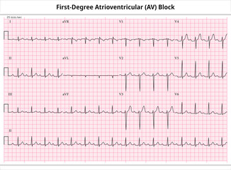 First Degree Atrioventricular Block - ECG Paper 12 Lead - Electrocardiogram - Vector Medical Illustration