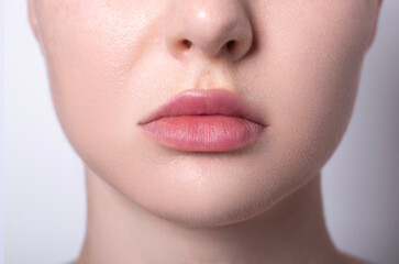 real woman lips after lip augmentation with hyaluronic acid filler injection finished result,...