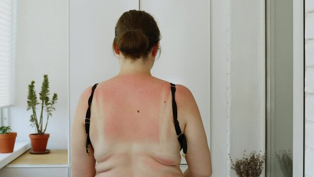 Young overweight woman stands in room and unbuttons black bra on her back with sunburn. Pale spots on skin after sunbathing in sun in swimsuit. Folds of skin on the thick back of person.