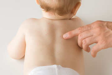 Young adult mother finger pointing to newborn bare back with red rash. Allergy from milk formula or...