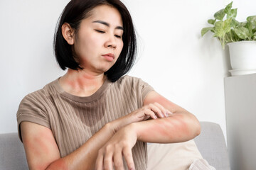 Asian woman has allergic to her own sweat hand scratching itchy, rash skin because of hot weather makes her skin redness - obrazy, fototapety, plakaty