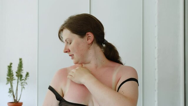 Young overweight woman without make-up touches sunburns on naked neckline with hand. Person is standing with lowered straps of black bra, examining burnt, reddened skin on shoulders.