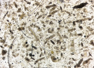 Microscopic urine examination showing Granular cast, a sign of many types of kidney diseases.