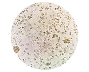 Pyuria or leukocyturia is the condition of urine containing white blood cells or pus. It can be a...
