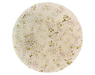 Pyuria or leukocyturia is the condition of urine containing white blood cells or pus. It can be a...