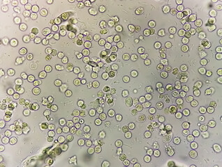 Pyuria or leukocyturia is the condition of urine containing white blood cells or pus. It can be a...