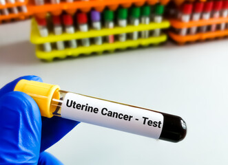 Blood sample for Uterine cancer test, CA 125.