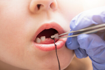 Extraction of a milk tooth in a child. Self-extraction of a tooth with a floss at home. Tie a floss...