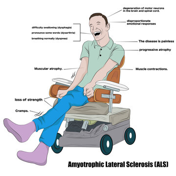 Nervous system disease that weakens muscles and affects physical functions