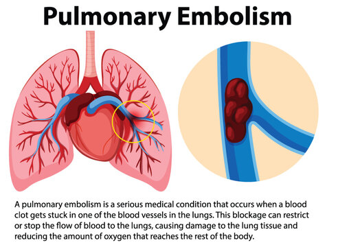 Pulmonary embolism with explanation