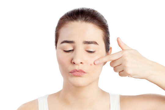 Woman  shows a finger to a red pimple on her face health problems acne. Problematic skin. Close-up photo on a white background