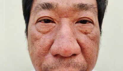 portrait showing the Freckles and blemish, dark spots and rough skin, acne and pimple on the face of a man, health care and beauty concept.