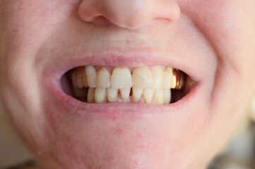 Close-up photo of natural looking teeth of a aged woman.