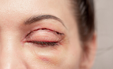Plastic surgery of the face, skin tightening around the eyes. Surgical procedure to strengthen the skin of the eyelids, remove fatty hernias in the eyes. Operational blepharoplasty.
