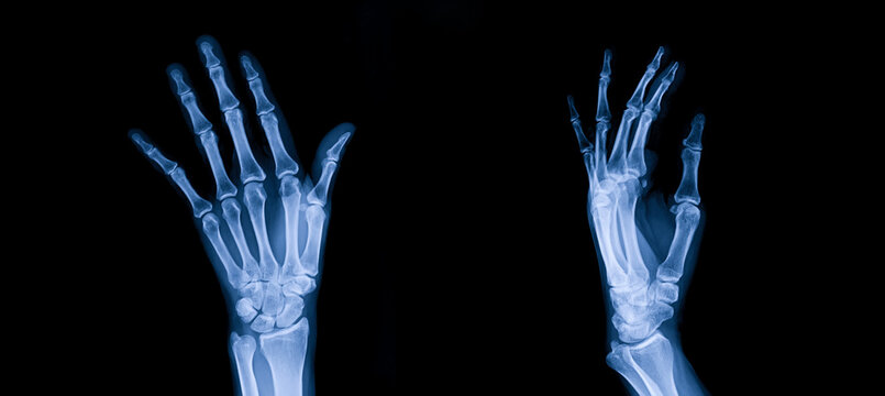 Blue tone radiograph on dark background in hospital.Doctor used xray for diagnosis of the illness of patient.Normal x-ray of both hands. Osteoarthritis of hand and joint. X-ray both hands in hospital.
