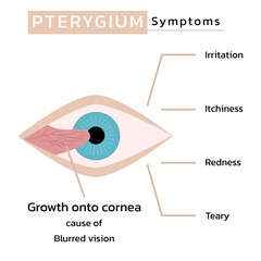 Pterygium signs and symptoms , vector