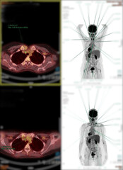 Positron emission tomography (PET) CT scan uses a radioactive drug (tracer) to show both normal and...