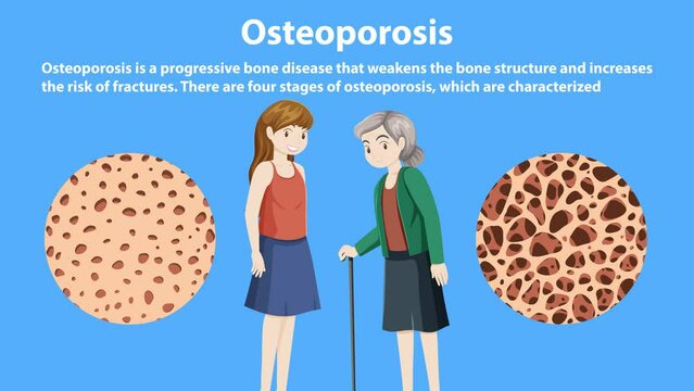 Stages and Progression of Osteoporosis Animation