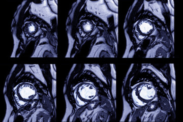MRI heart or Cardiac MRI in short axis view showing cross-sections of the left and right ventricle...