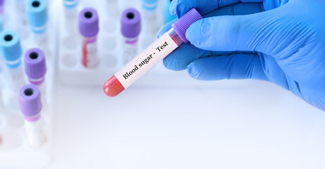 Doctor holding a test blood sample tube with Sugar test on the background of medical test tubes with analyzes.Copy space for text