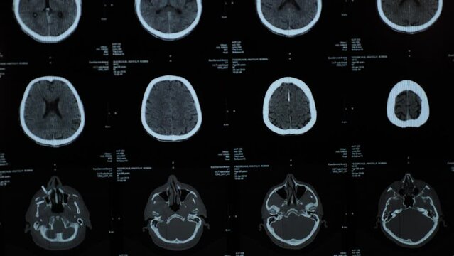 Magnetic resonance imaging, MRI of human brain after traumatic head injury, stroke, illness in elderly man in hospital. Examination by a neurologist