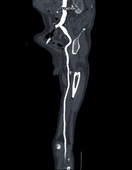 CTA femoral artery run  off MPR curve  showing Left  femoral artery for diagnostic  Acute or...