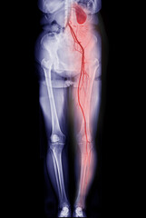 CTA femoral artery run off showing  femoral artery for diagnostic  Acute or Chronic Peripheral...