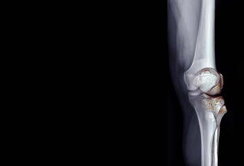 Film x-ray of  knee joint  AP view  fusion with 3D rendering knee joint  for medical background.