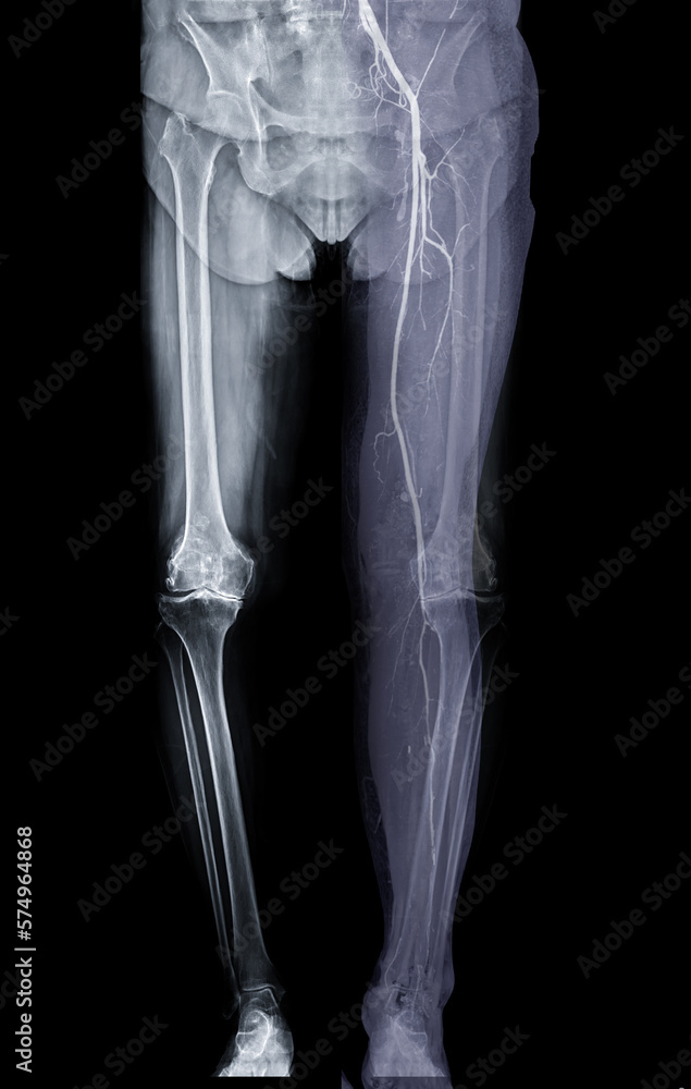 Poster scanogram image fusion with cta lower extremities.