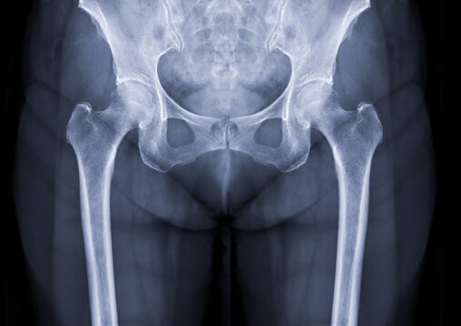 X-ray image of Both hip joint.