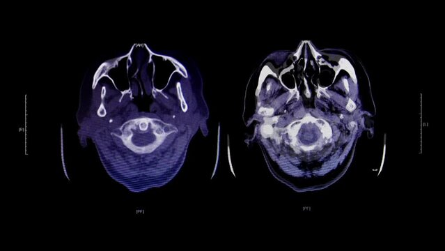 This stock motion graphics features Medical Brain Cat Scans & Cranial X-Rays analyzed on-screen.
