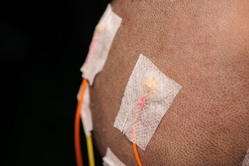 Electrodes for scalp electroencephalograohy examination.