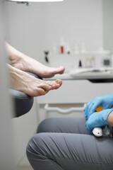 toes with onychomycosis in the podiatrist's office