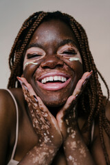 portrait of a pretty african woman with vitiligo smiling and posing with moisturizing cream on her face