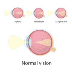 Ophthalmic concept, eye defects. Normal vision, Hyperopia, Myopia.