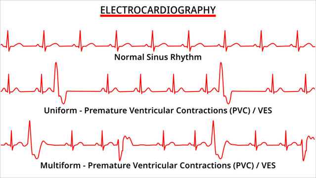 Set of ECG Common Abnormalities - Normal Sinus Rhythm - Uniform and Multiform Premature Ventricular Contractions (PVC) - Ventricle Extra Systole -  Electrocardiography Vector Medical Illustration