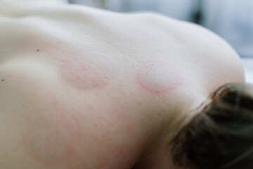 Anti-cellulite foot massage for a fat woman. Concept of personal care, weight loss, diet. Close-up.