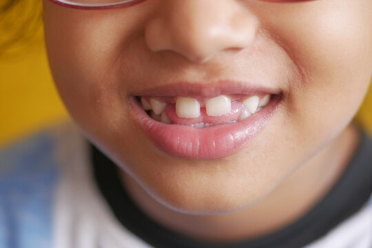 Child Girl With Deformed Teeth 