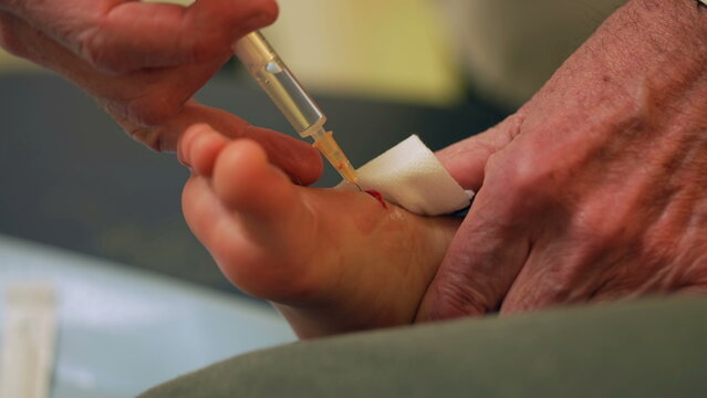 Doctor hand closeup applying local anesthesia with syringe on child feet injury. Medical clini injection treatment procedure