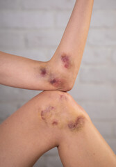 Close-up of bruises on the skin of an injured woman's arm and leg