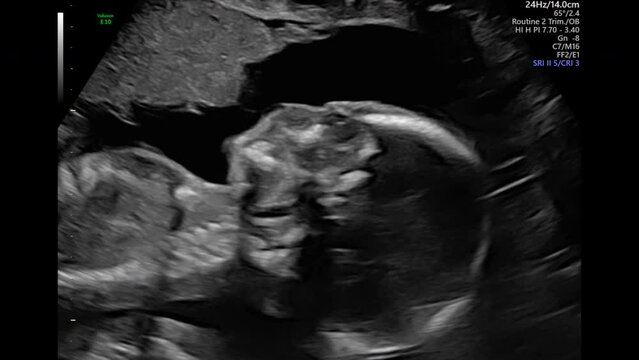 Tiny female baby rolls over in mother's abdomen. Baby in womb moves during ultrasound. 3D Screening, New Life, 30 Weeks of Life.