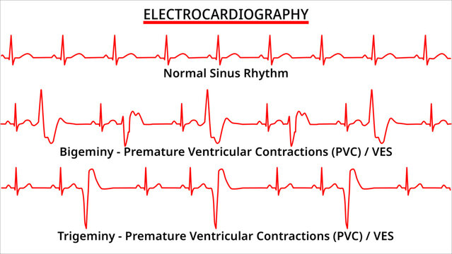 Set of ECG Common Abnormalities - Bigeminy vs Trigeminy Premature Ventricular Contractions (PVC) - Ventricle Extra Systole (VES) -  Electrocardiography Vector Medical Illustration