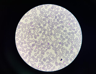 Malaria pigment blood parasite infected rbc.